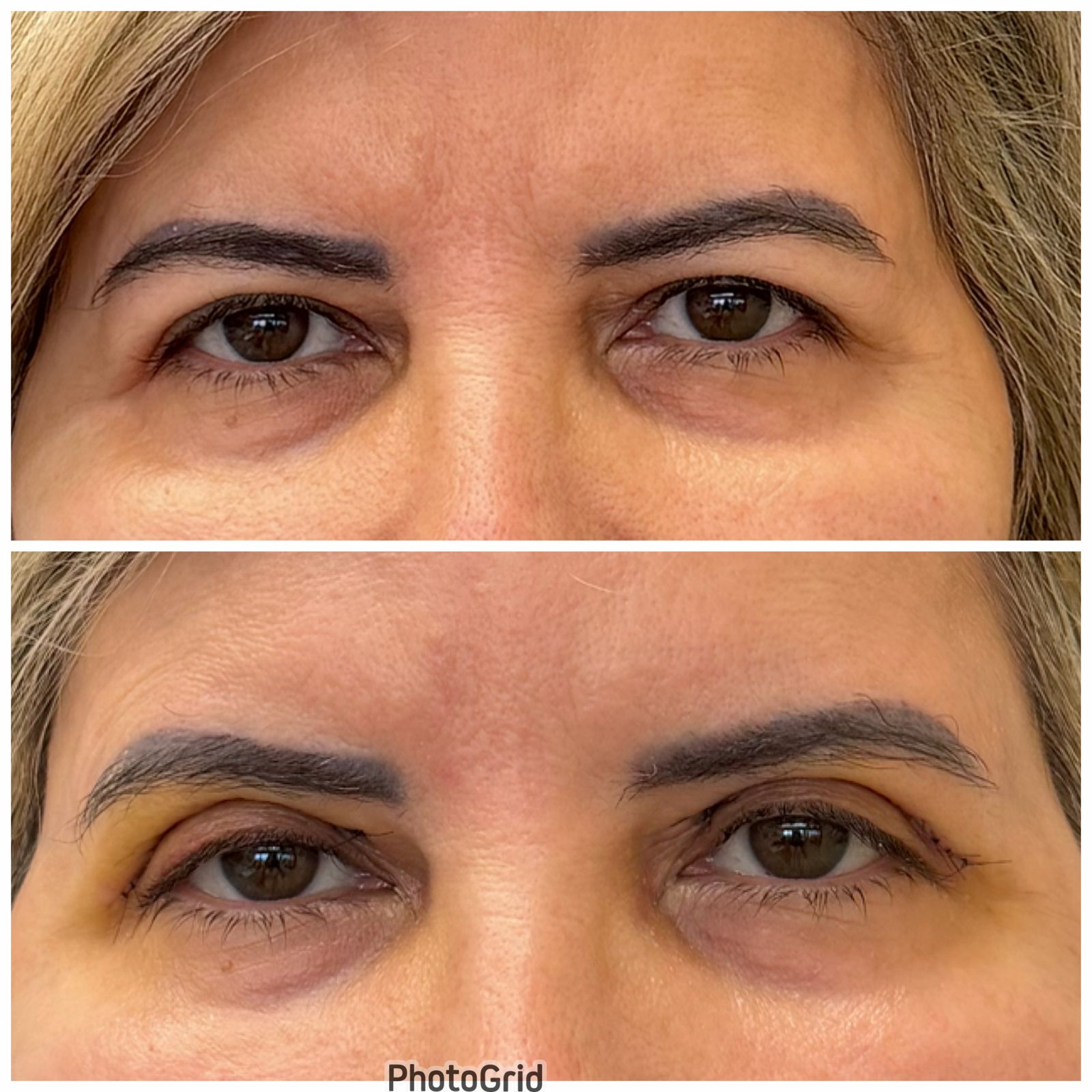 Caso 1 — resultado de blefaroplastia