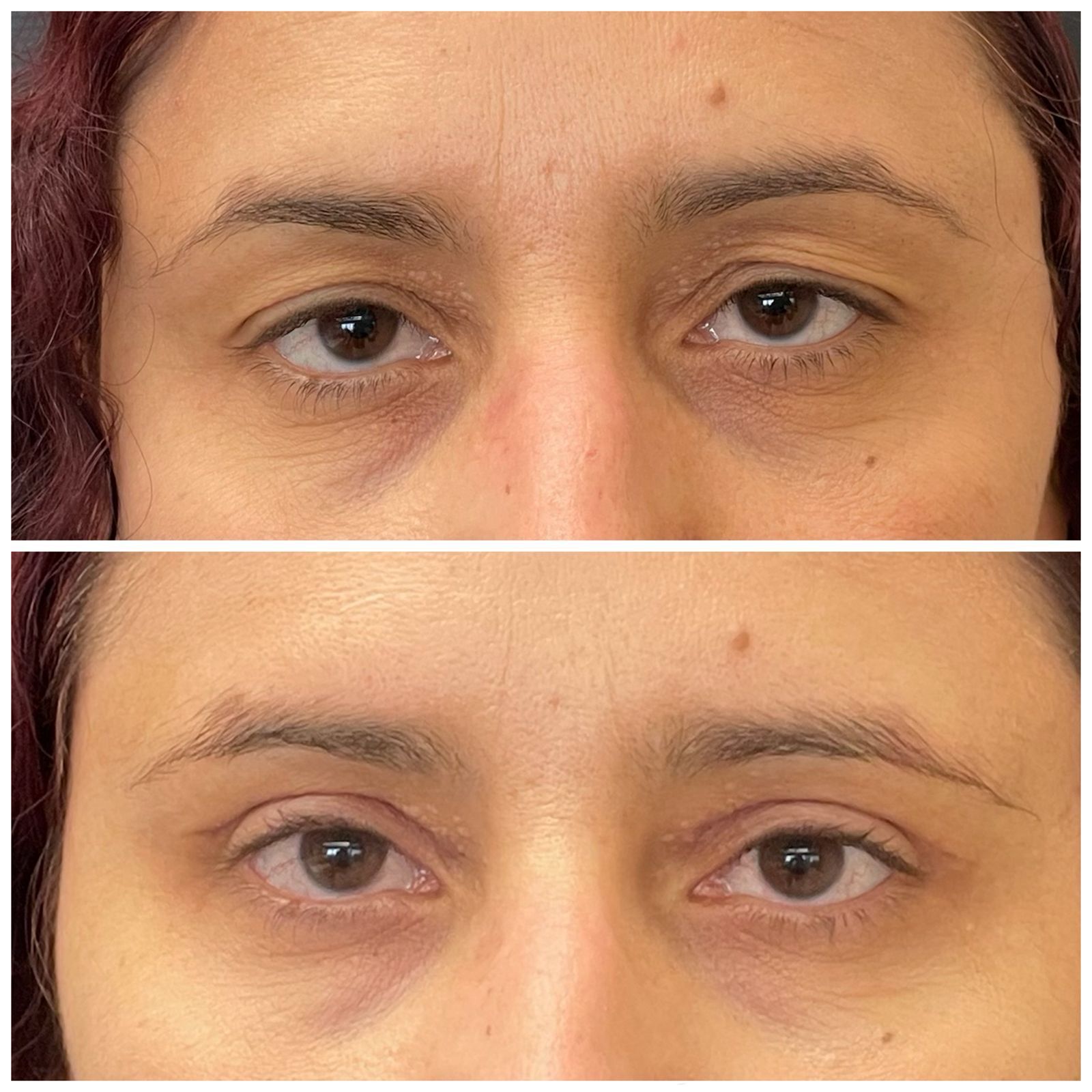 Caso 3 — resultado de blefaroplastia