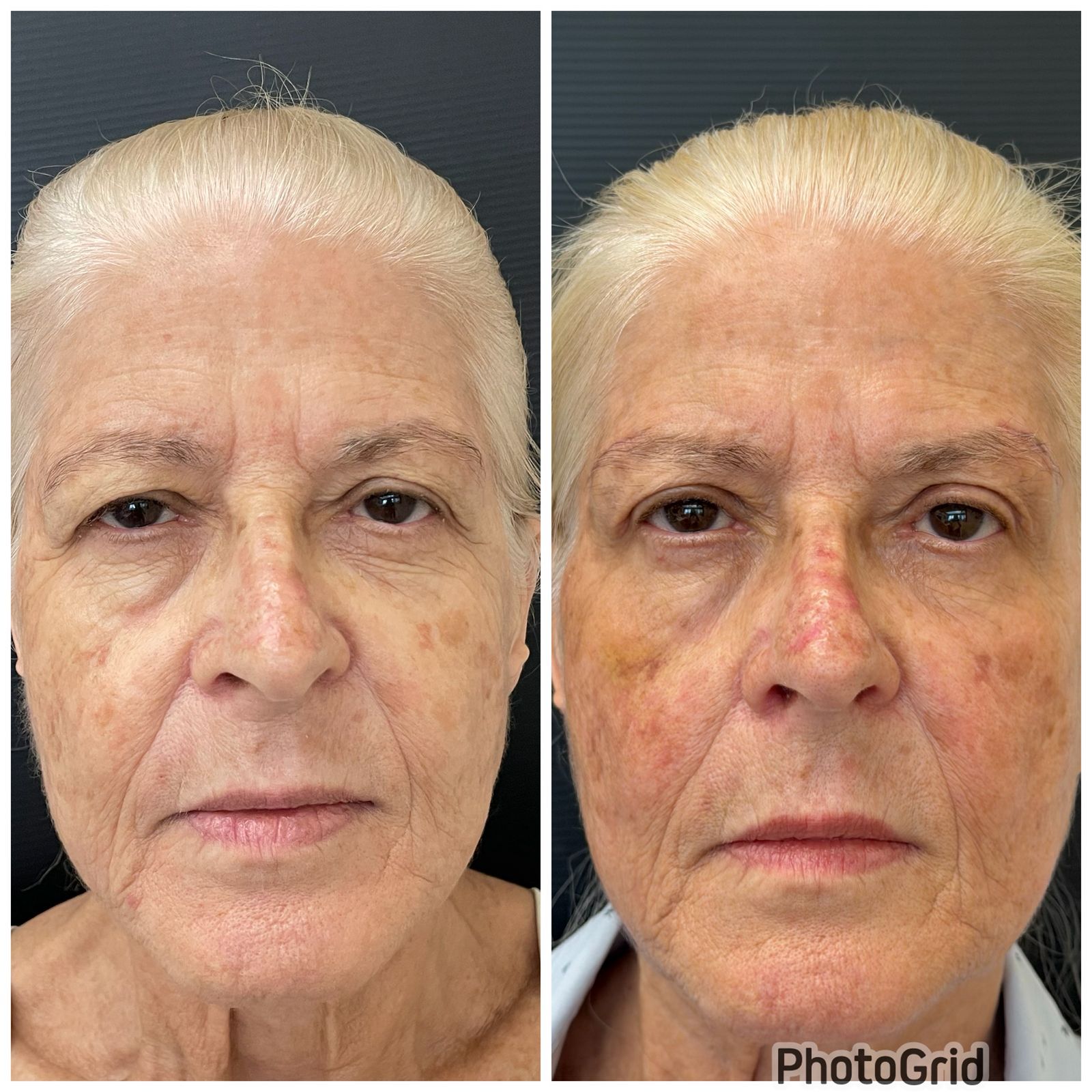 Caso 2 — resultado de blefaroplastia